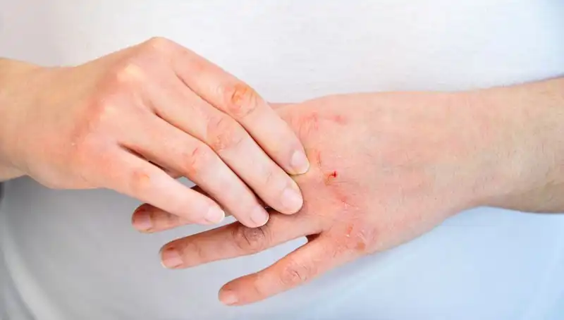 Yetersiz Protein Tüketimi: Altı Belirtilerle Tespit Edin